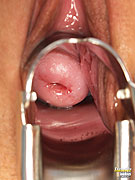 Speculum closeup pic